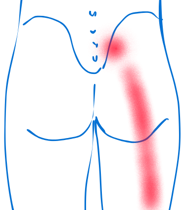 low back pain