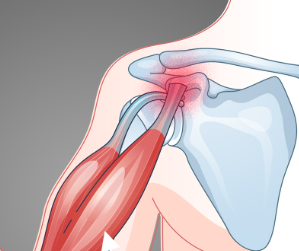 shoulder pain